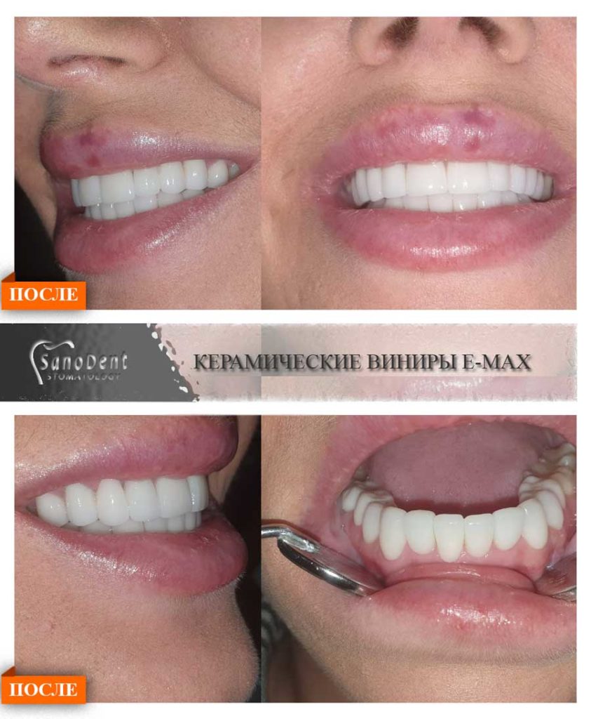 керамические виниры после протезирования