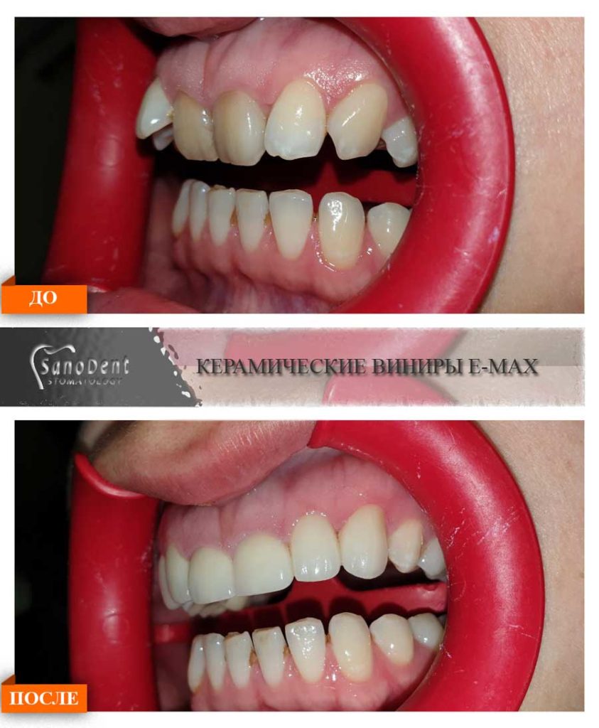 керамические виниры вид сбоку работа до и после протезирования