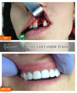 имплантация переднего зуба
