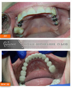 имплантация жевательных зубов верхней челюсти