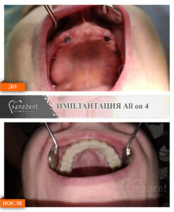 Имплантация всей челюсти на четырех имплантатах. All on four.