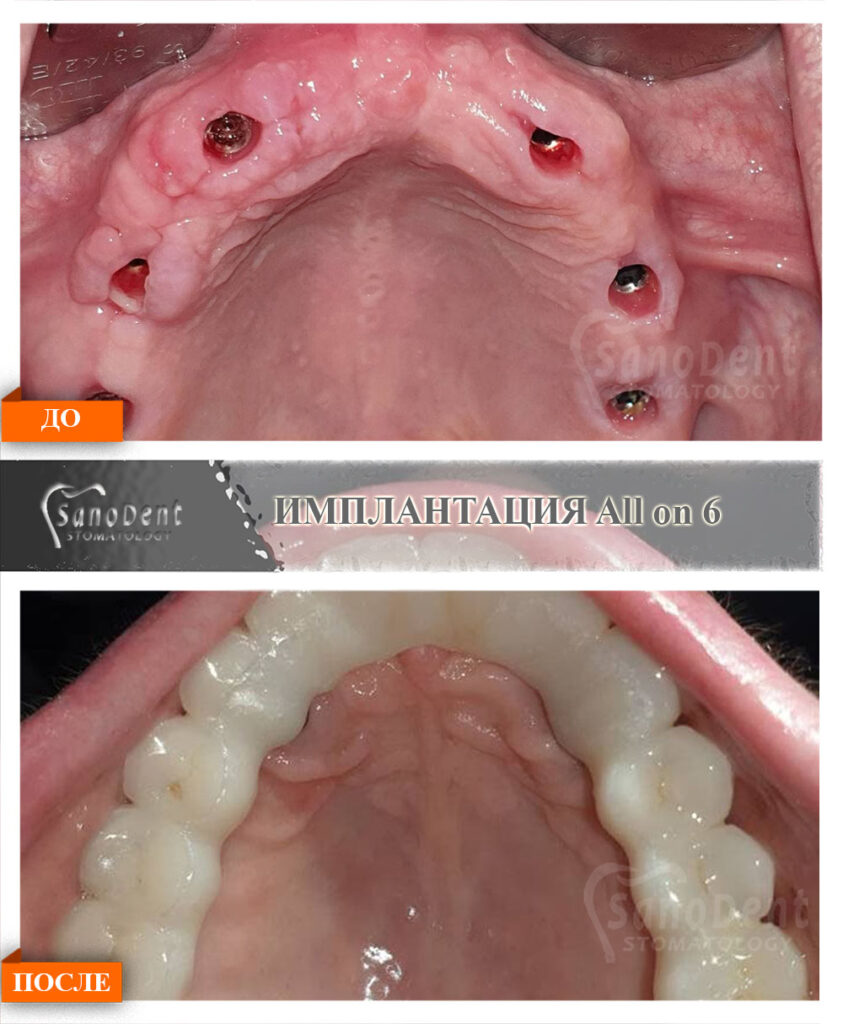 all on 6 имплантация зубов все на шести в Харькове