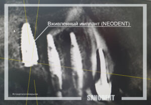 рентген интегрированного импланта Неодент Neodent в Харькове, имплантация зубов Санодент Харьков