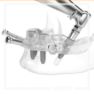 установка имплантов с помощью хирургического шаблона