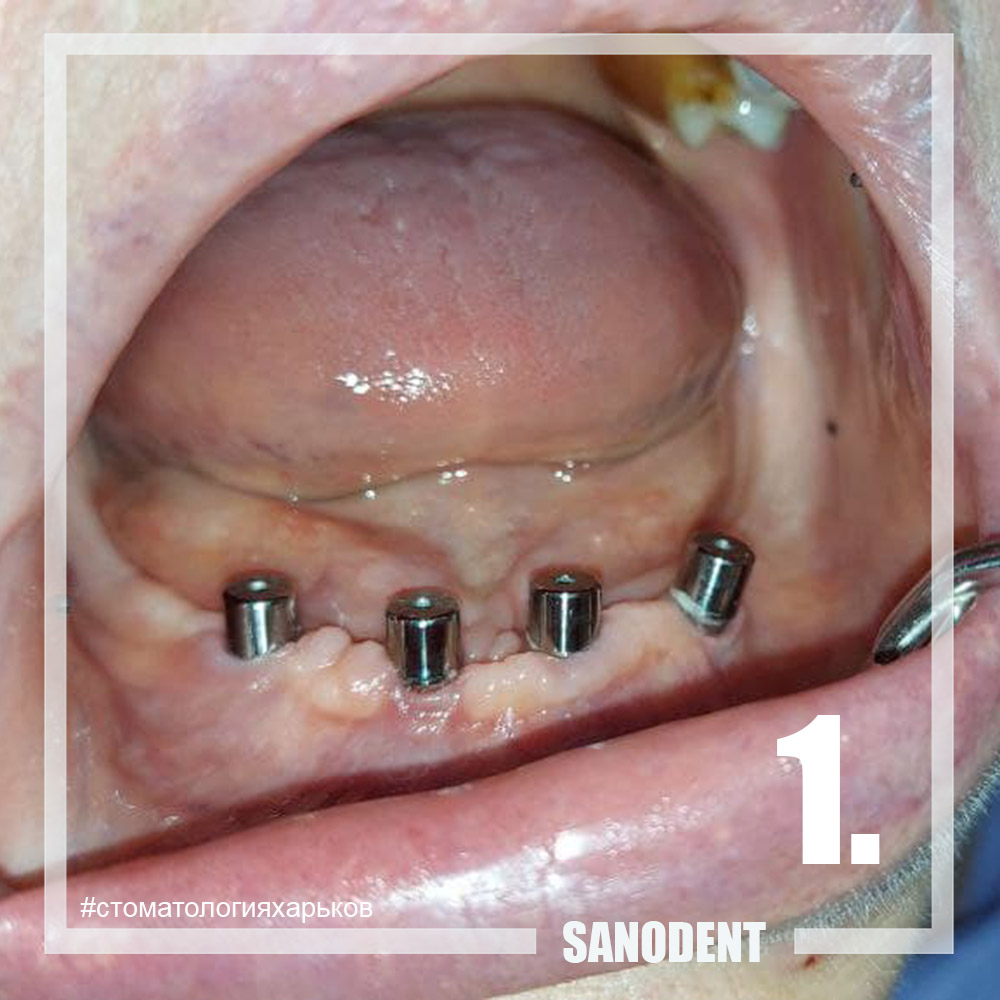 имплантация зубов в Харькове