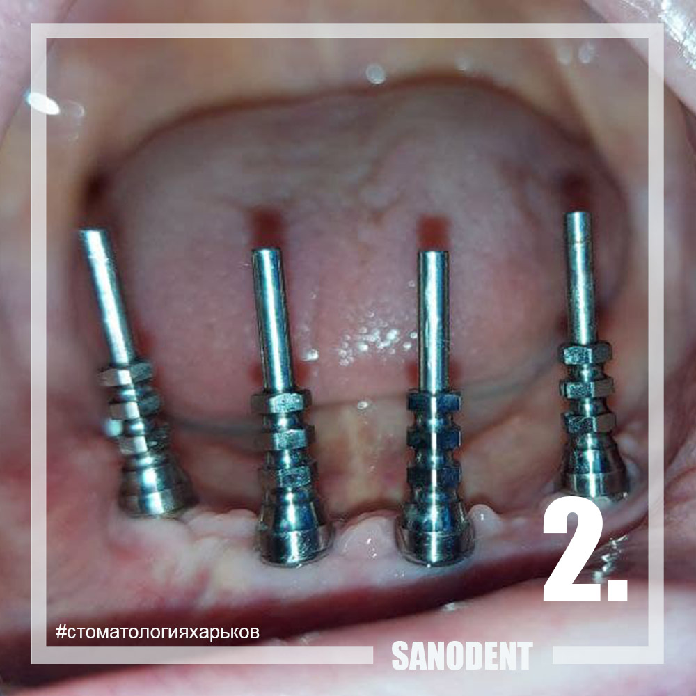 все на четырех имплантация зубов