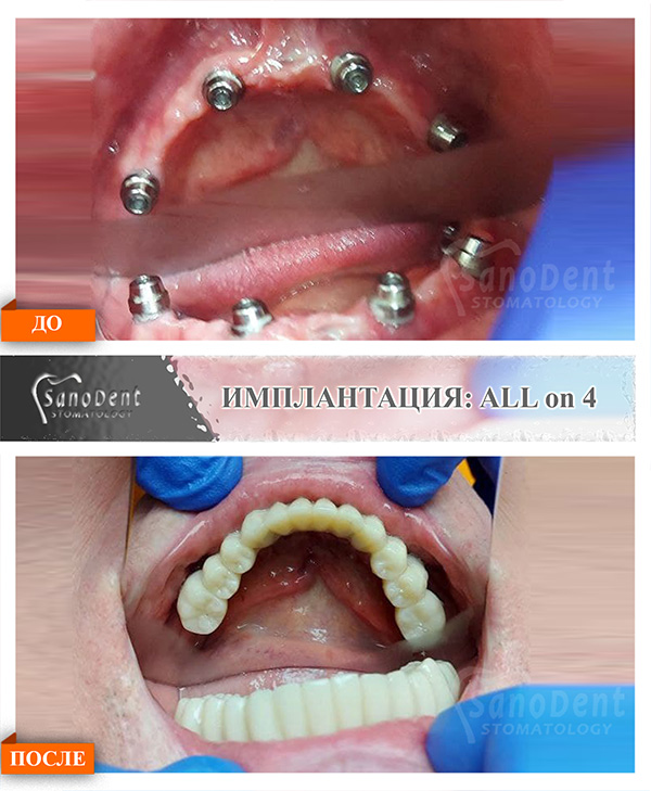 all on 4 протезирование зубов