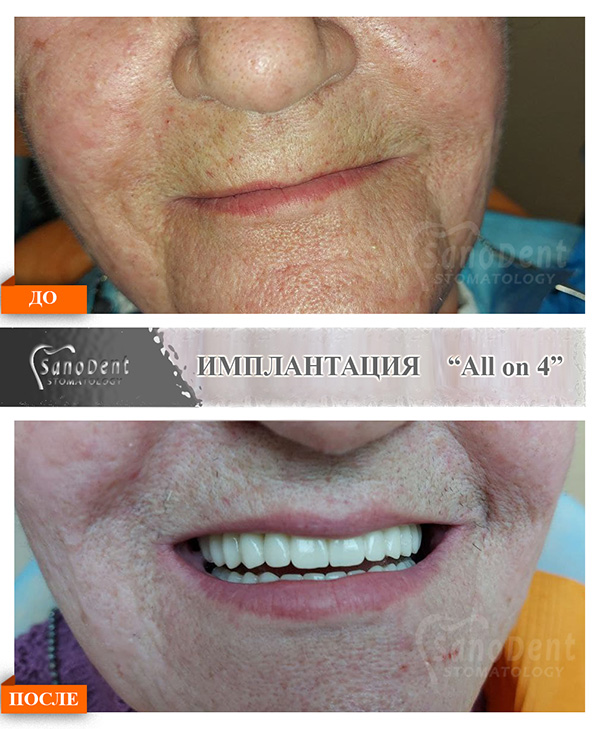 имплантация зубов all on 4