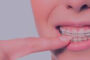 Що впливає на вартість брекет системи, вартість виправлення прикусу за допомогою брекетів у Харкові