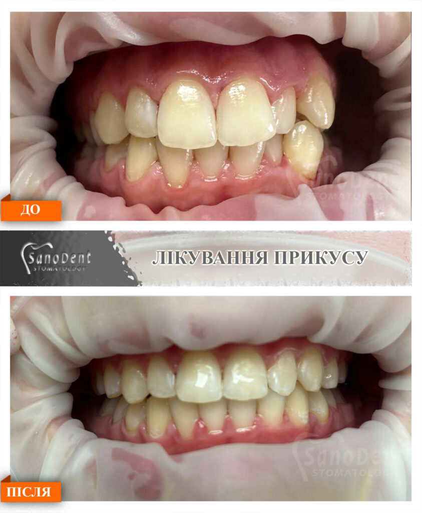 Фото до та після брекетів