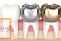 Сучасні коронки, які обрати для протезування зубів?