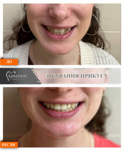 фото наших ортодонтических работ, брекеты до и после