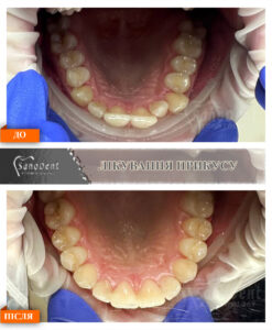 фото наших ортодонтических работ, брекеты до и после