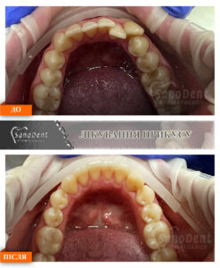 фото наших ортодонтических работ, брекеты до и после