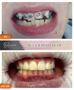 фото наших ортодонтических работ, брекеты до и после