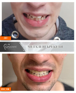 фото наших ортодонтических работ, брекеты до и после