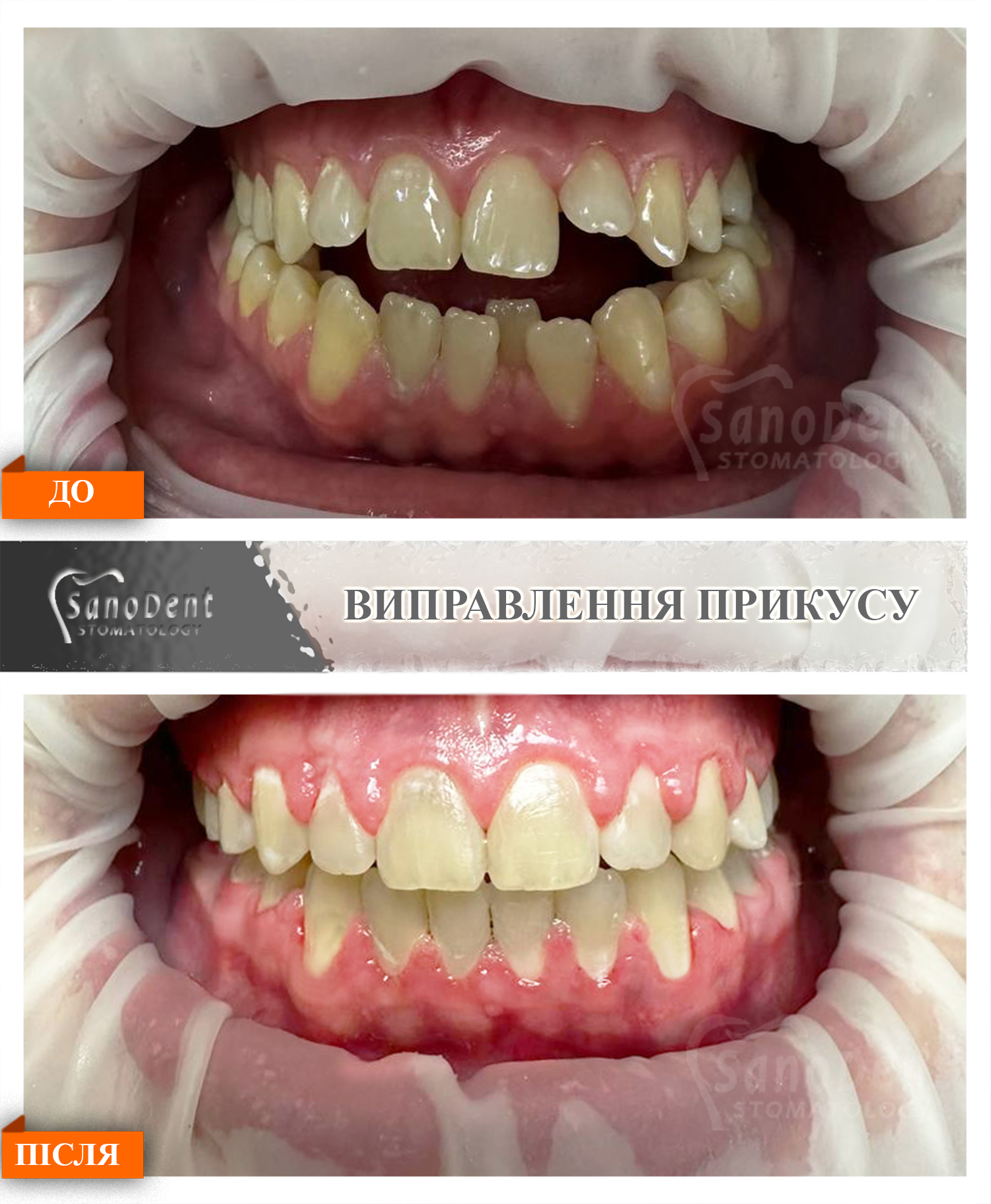 ramka-do-posle-open-bite-braces-1 открытый прикус лечение в Харькове, фото до после