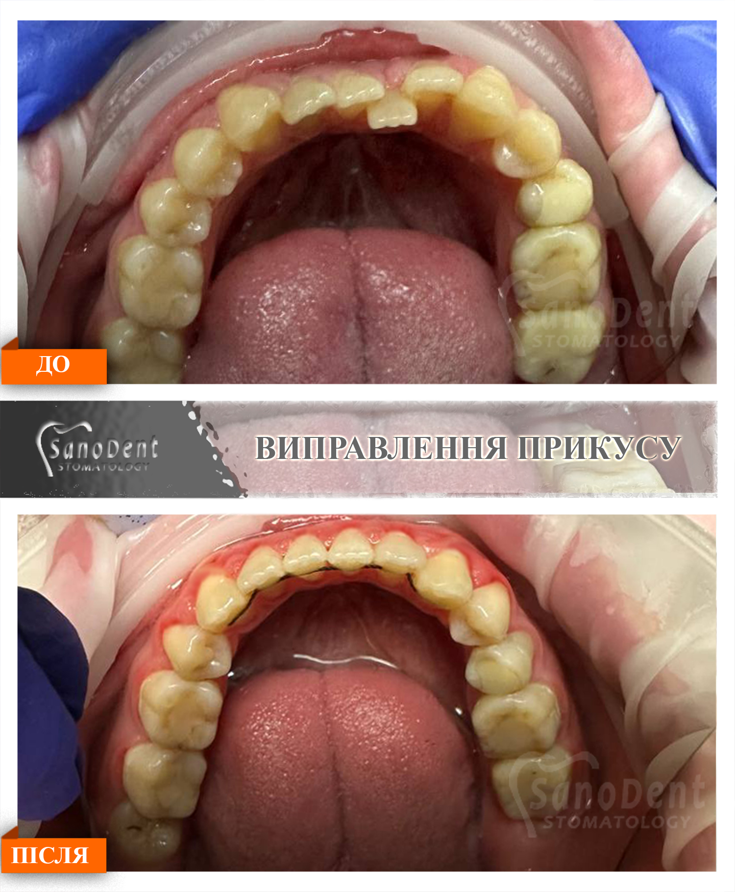 ramka-do-posle-open-bite-braces-2 установка брекетов в Харькове, лечение прикуса фото