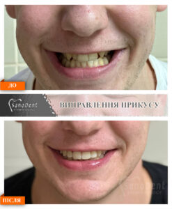 исправление неправильного прикуса фото до и после