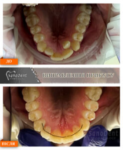 исправление неправильного прикуса фото до и после