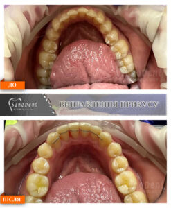 исправление неправильного прикуса фото до и после