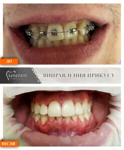 исправление неправильного прикуса фото до и после