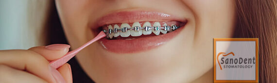 Догляд та рекомендації після встановлення брекетів у Харкові