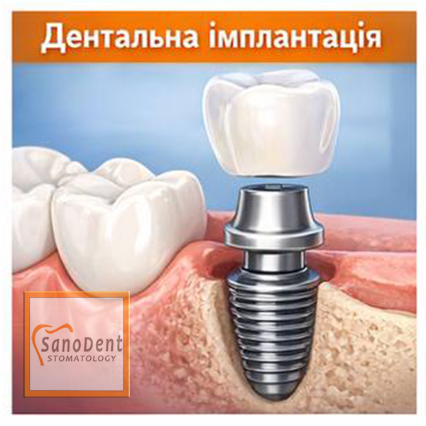 имплантация зубов