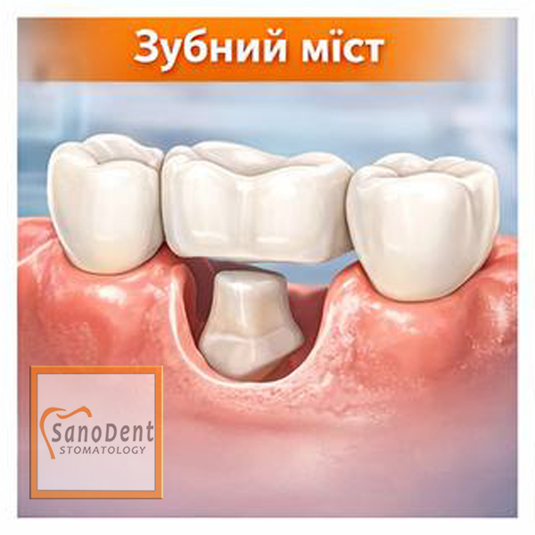 мостовидный зубной протез