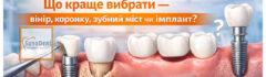 когда и что лучше выбрать -- имплантацию, протезирование мостом, или виниры