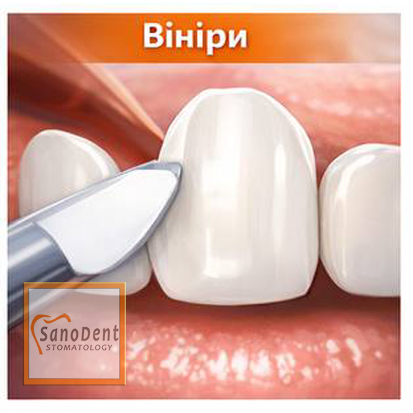 виниры на зубы, протезирование